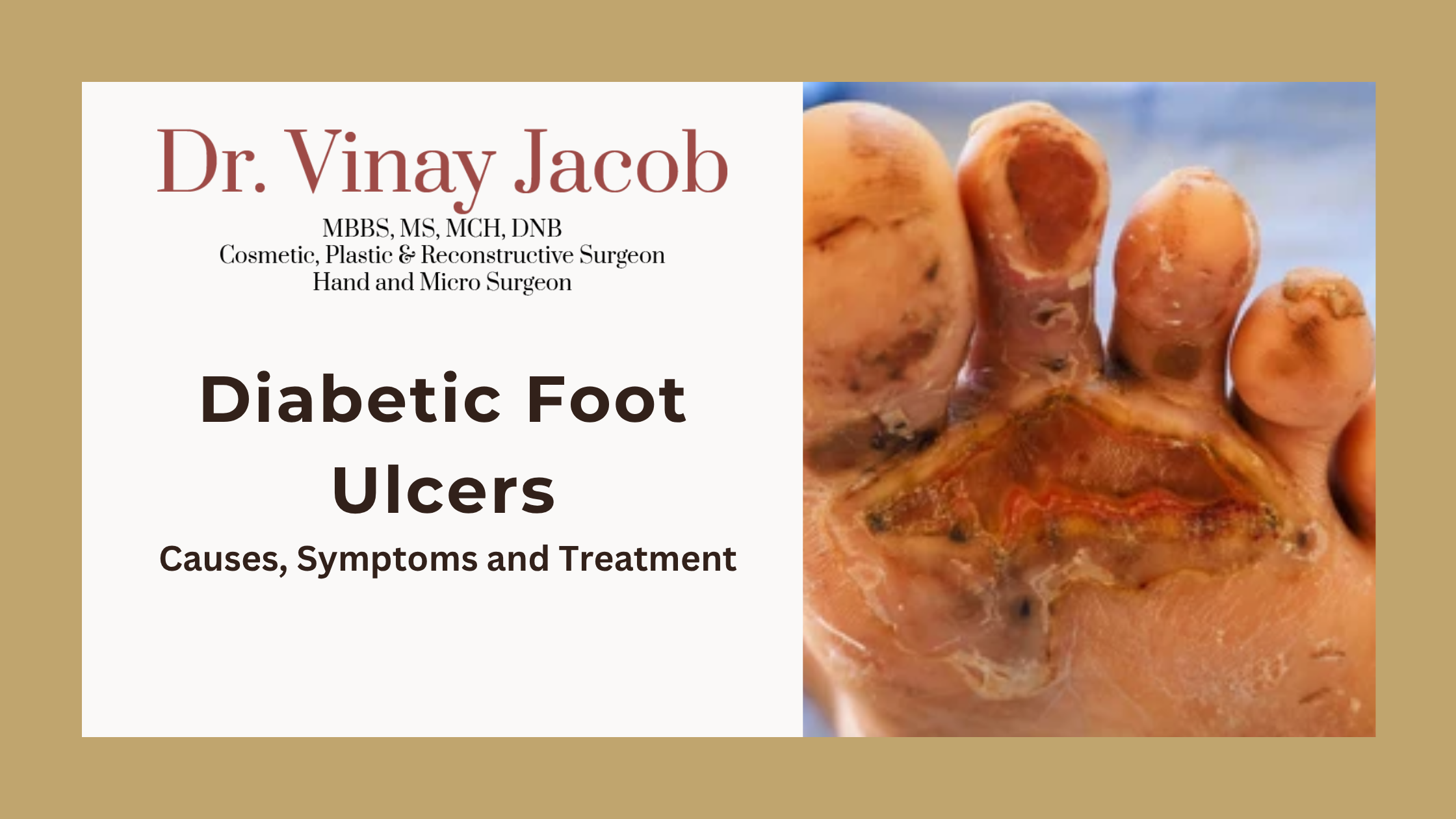 Diabetic Foot Ulcers: Causes, Symptoms and Treatment Options