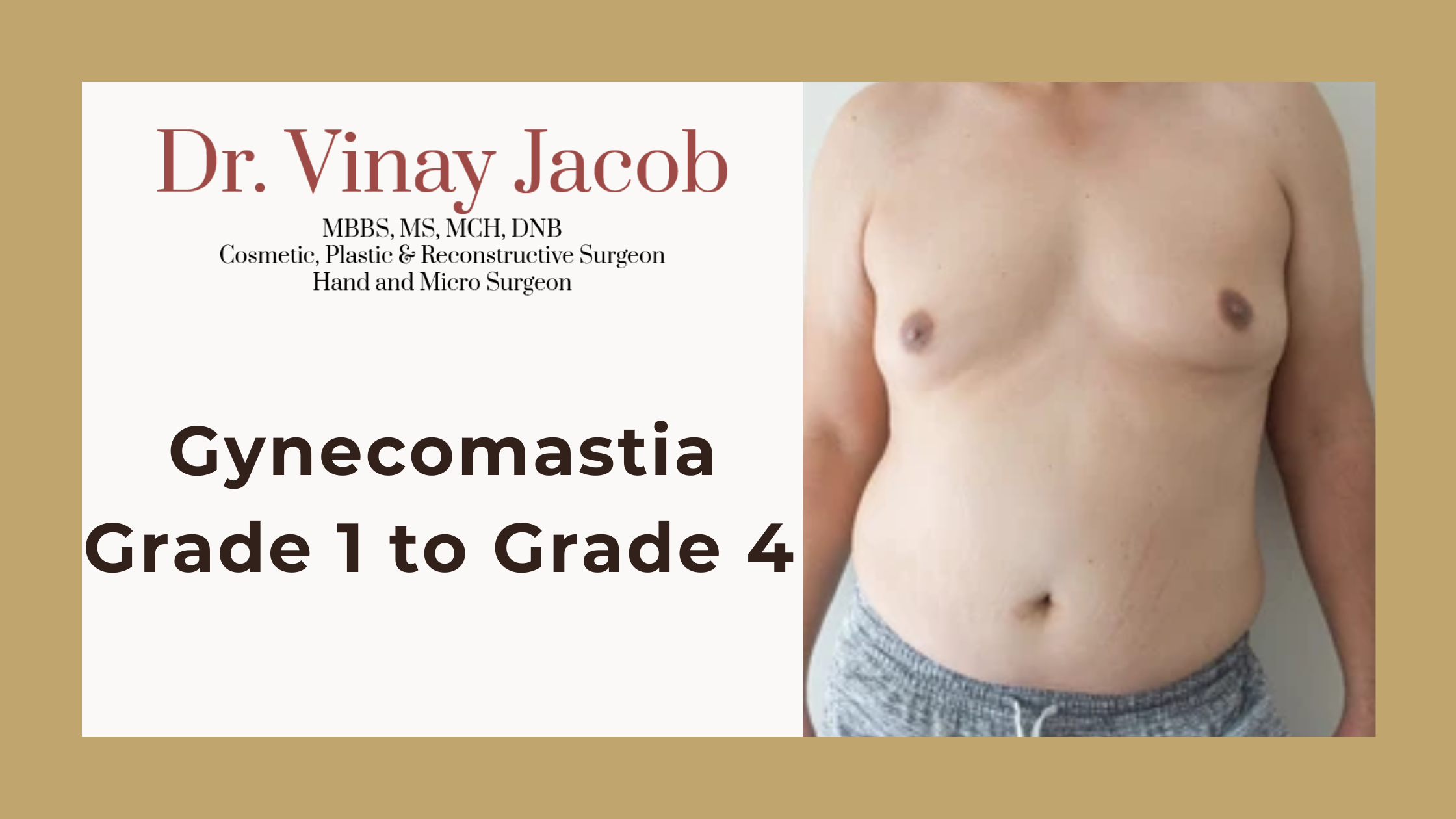 Gynecomastia Grade 1 to Grade 4 Explained