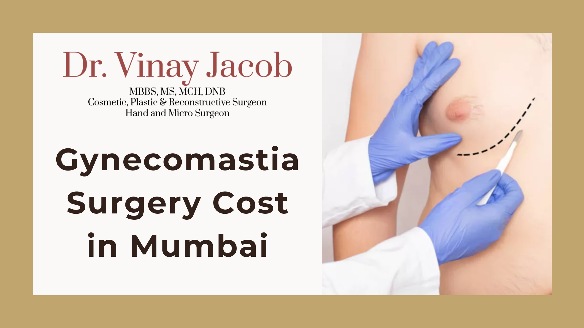 Gynecomastia Surgery Cost in Mumbai: Complete Guide