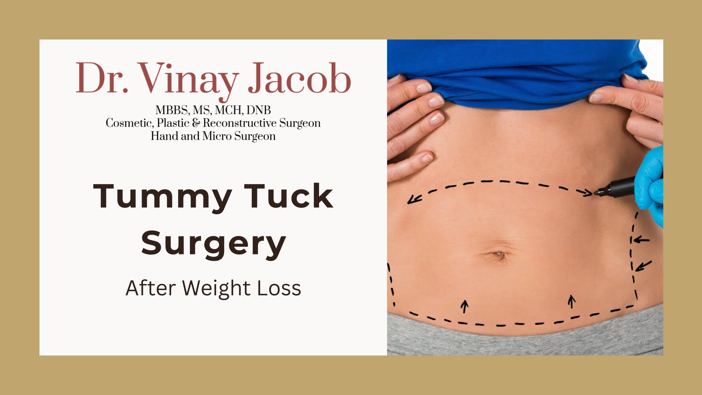 Tummy Tuck Surgery After Weight Loss: Is It Necessary?