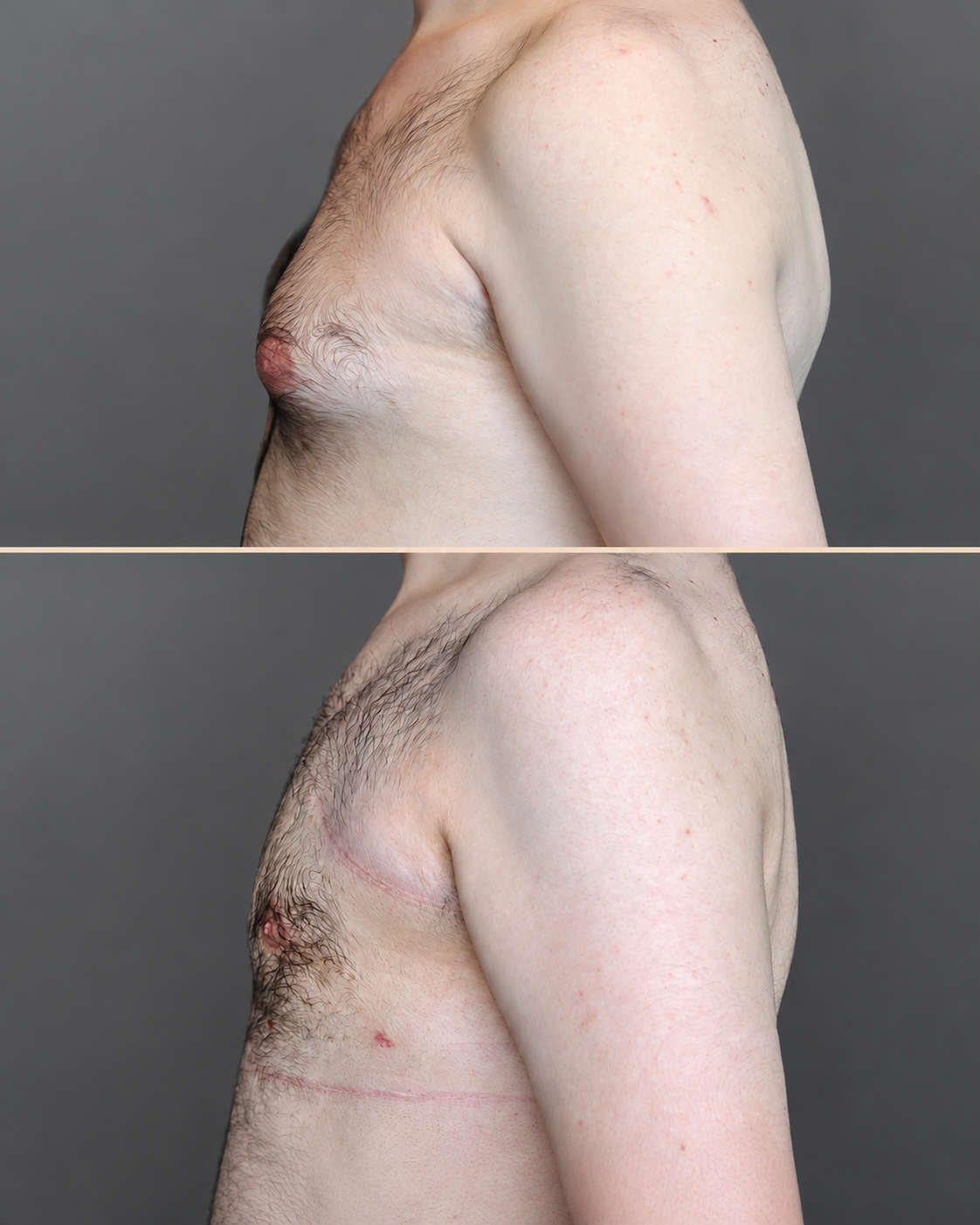 Gynecomastia surgery before and after - patient 1