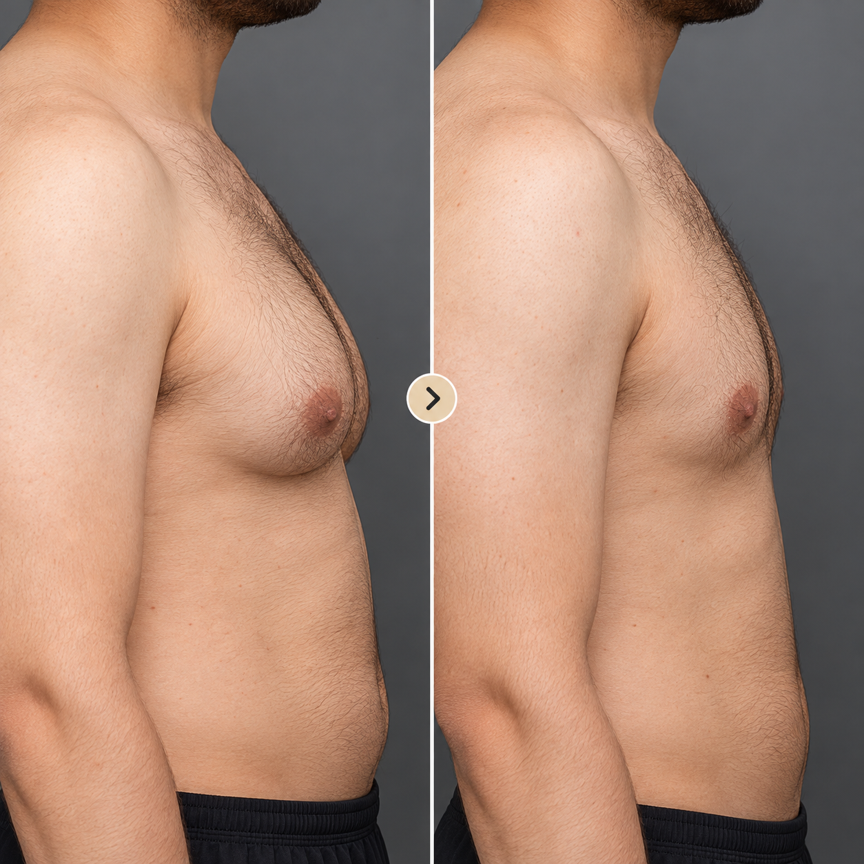 Gynecomastia surgery before and after - patient 3