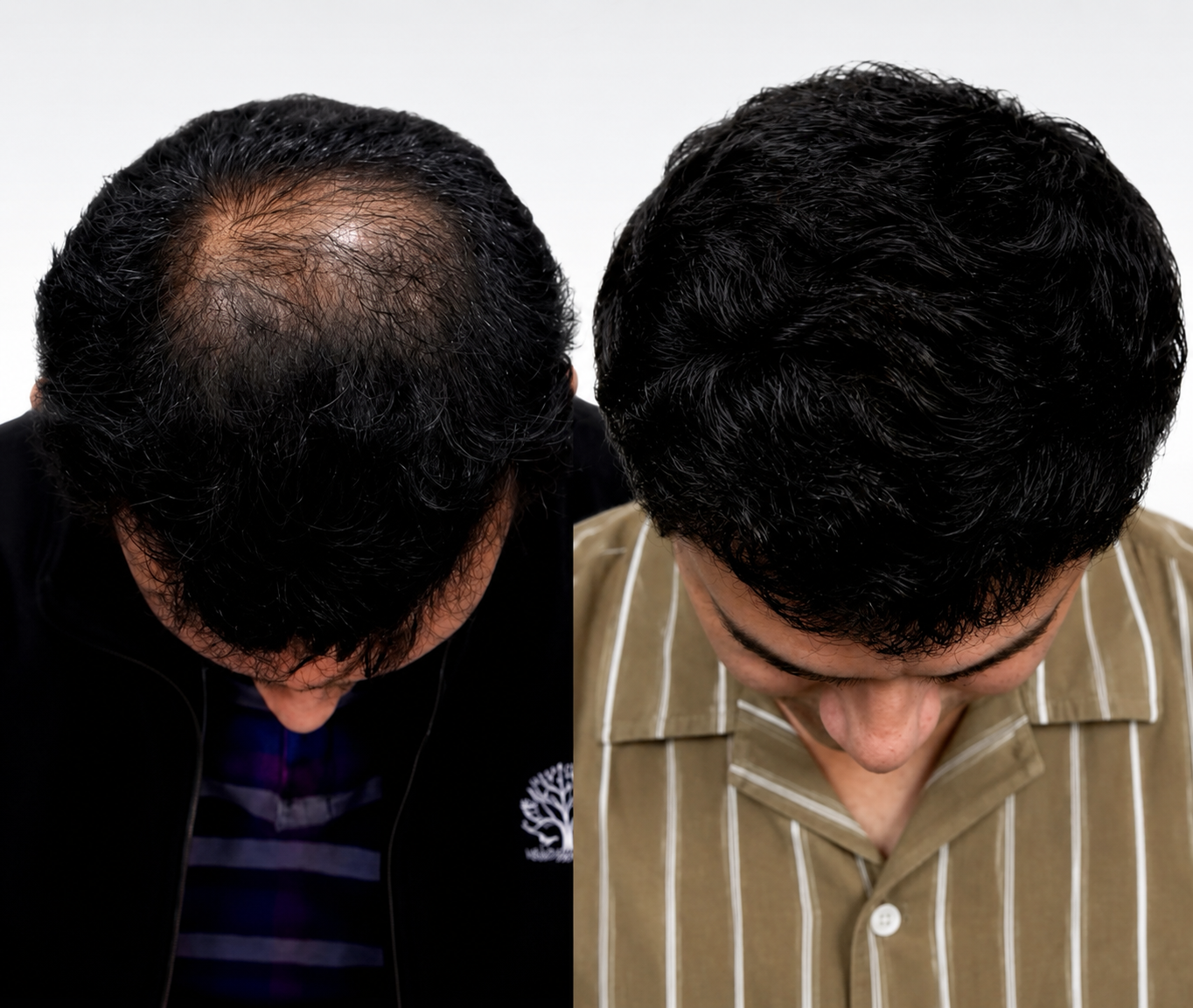 Hair Transplant Before and After Results