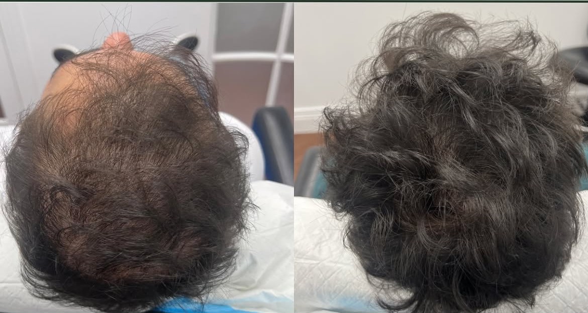 Hair Transplant Before and After Results