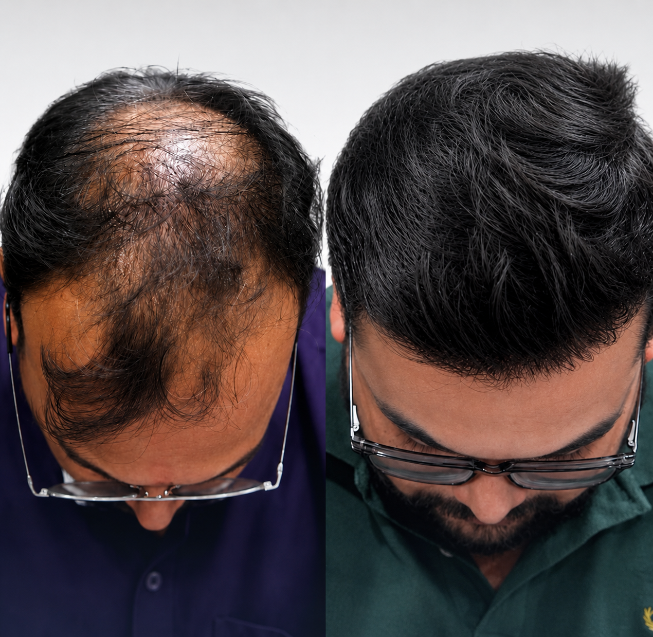 Hair Transplant Before and After Results