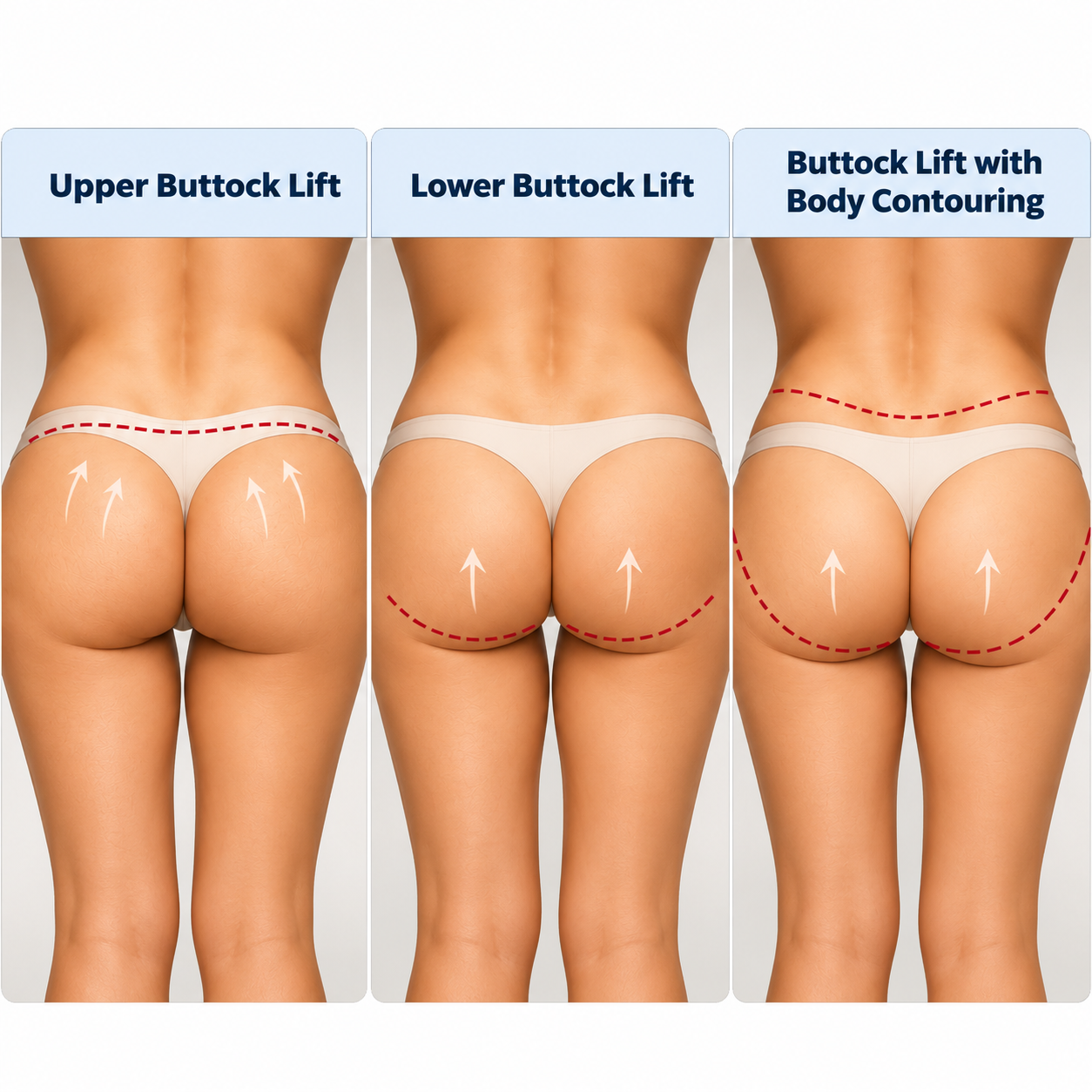 Medical illustration showing buttock lift and body contouring treatment areas