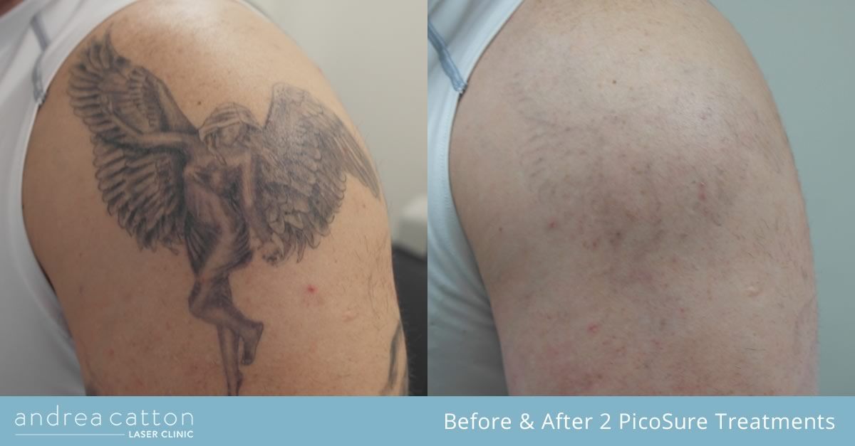 Gradual fading of a tattoo after laser removal sessions