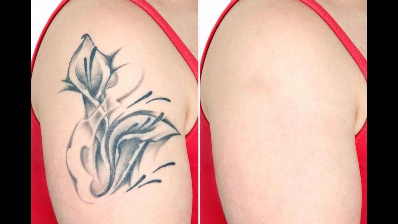 Different types of tattoos treated with laser removal