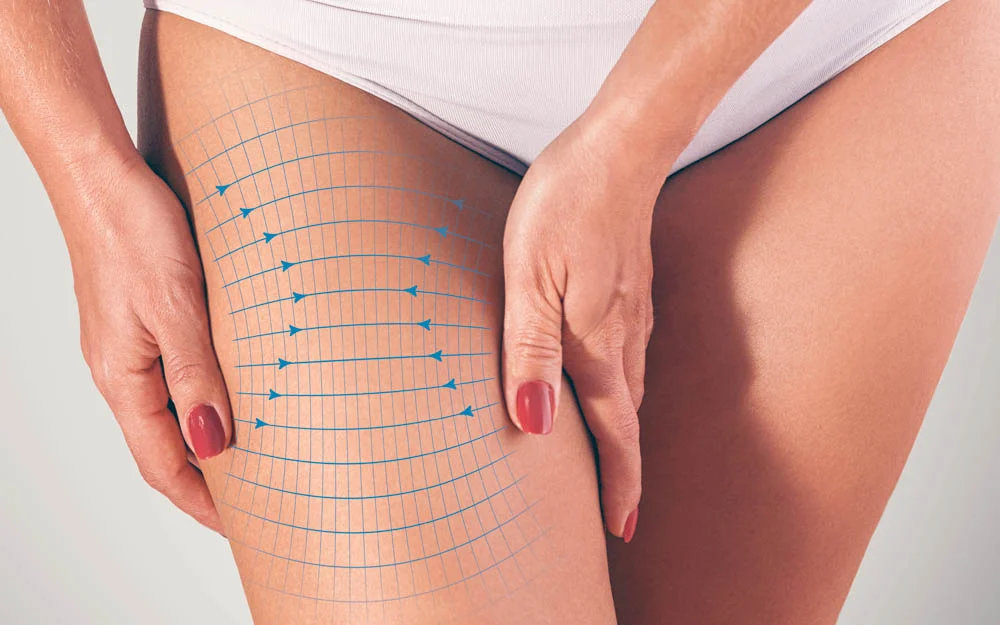 Medical illustration showing types of thigh lift procedures