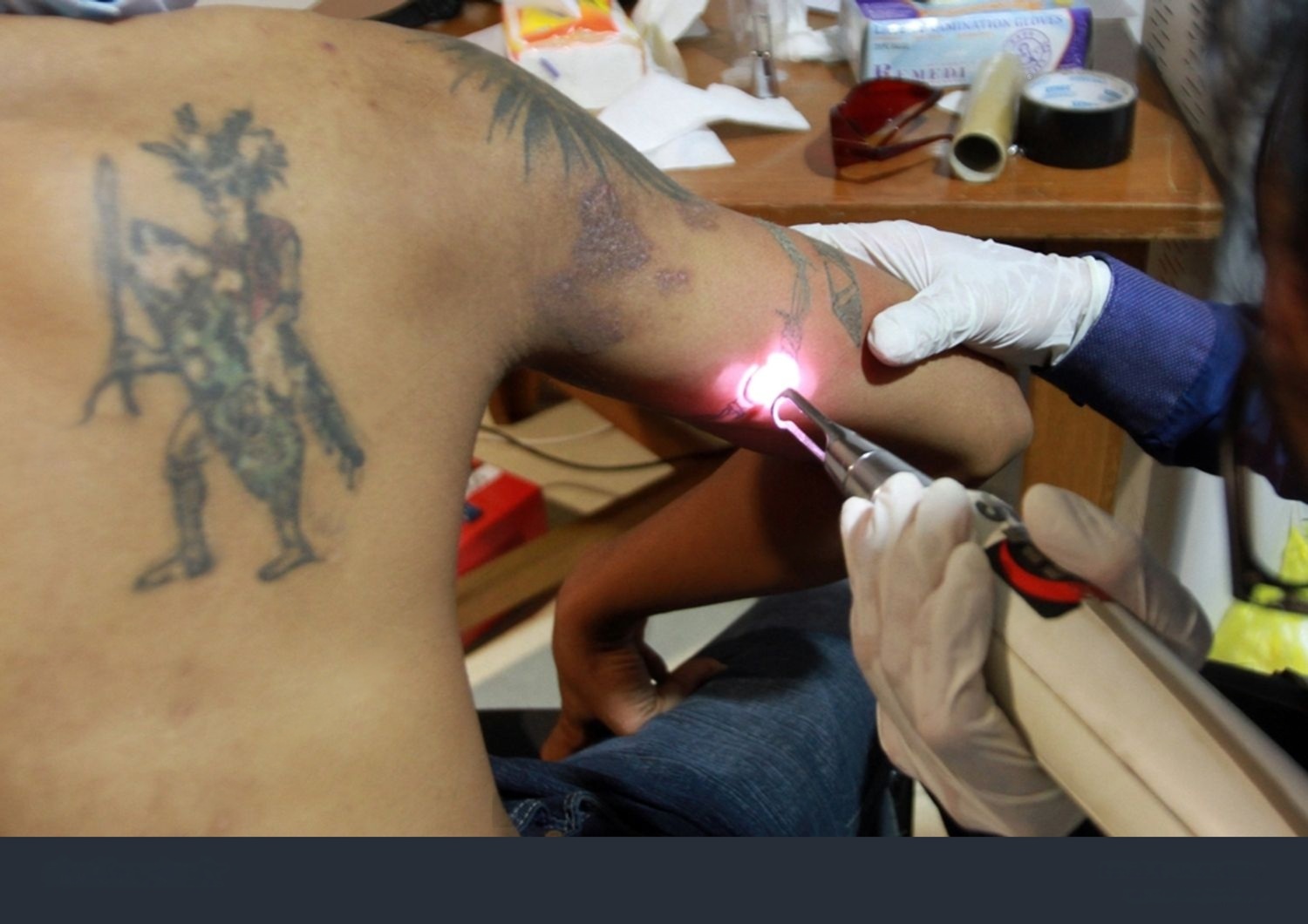 Tattoo removal candidate