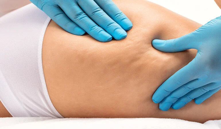 Thigh lift surgery candidate